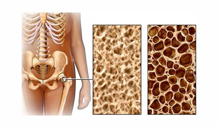 Osteoporose botstructuur
